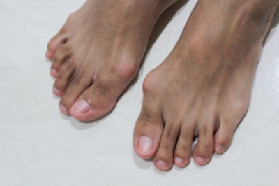 Managing Bunions